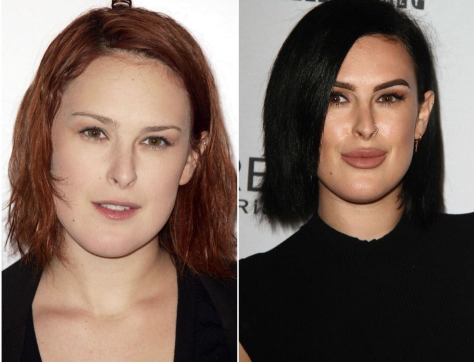Rumer Willis Plastic Surgery and Transformation – Before and After ...