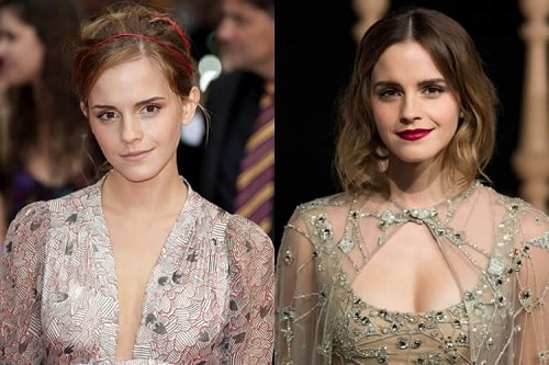 Emma Watson Breast Nose And Teeth Implant Before And