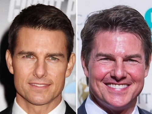 Tom Cruise’s Face Plastic Surgery – Before and After Pictures Sparks ...