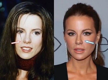 Kate Beckinsale Plastic Surgery Transformation – Before and After ...